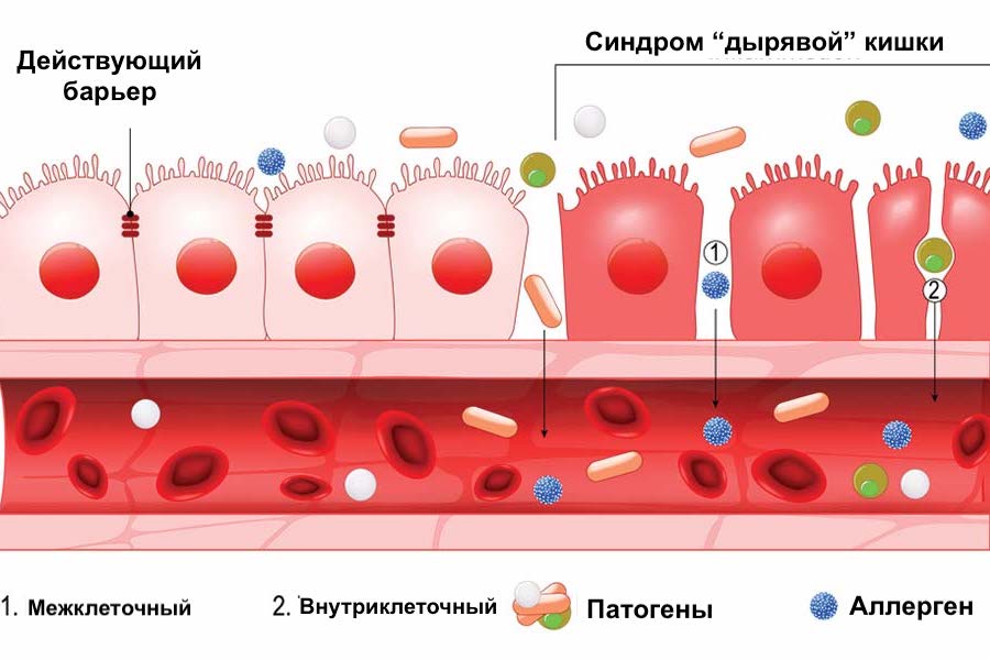 Lekkiva soole sündroomi diagramm